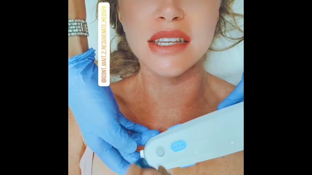 Ultherapy in Orange county @anninetheesti