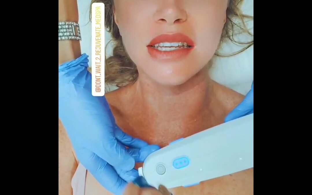 Video: Ultherapy in Orange county @anninetheesti