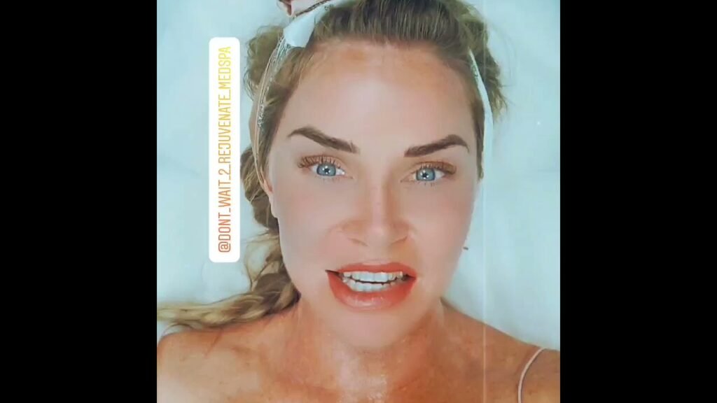 Ultherapy in Orange County  @Anninetheesti