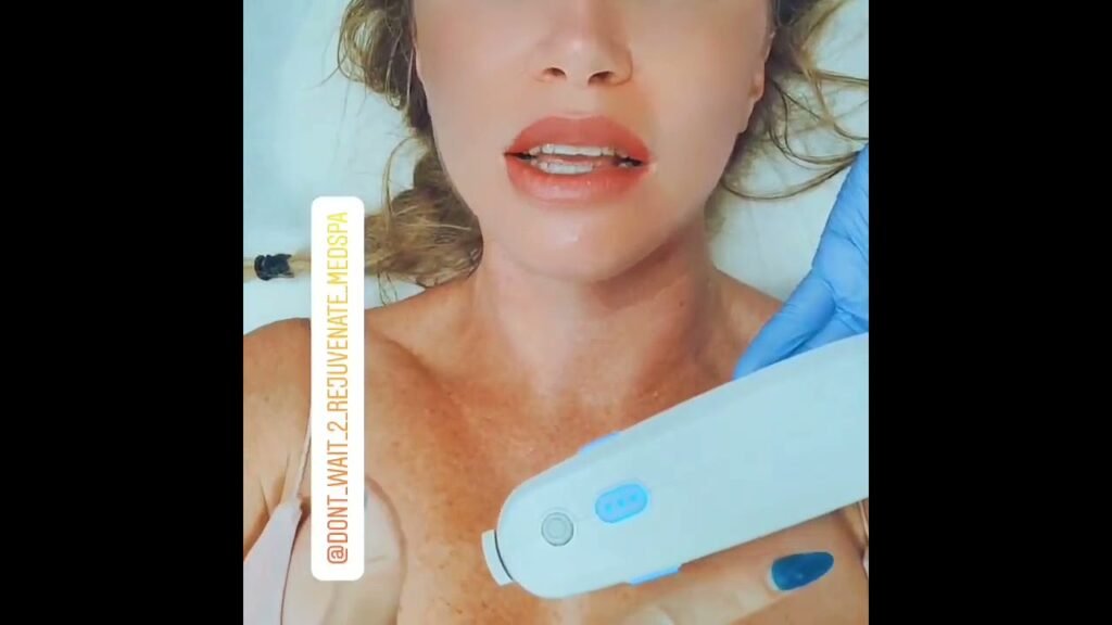 Ultherapy is like A mini Face Lift! follow @anninetheesti for before and afters!