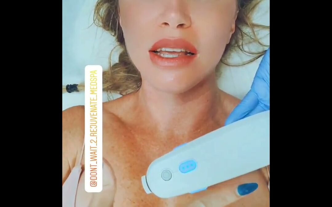 Video: Ultherapy is like A mini Face Lift! follow @anninetheesti for before and afters!