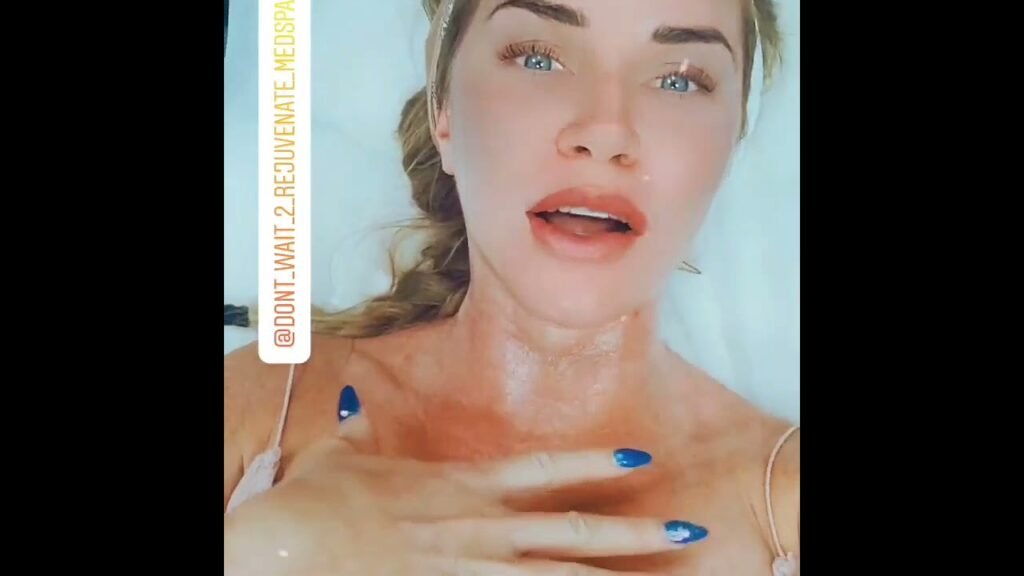 Ultherapy in Orange County.  Follow @Anninetheesti for before and after photos