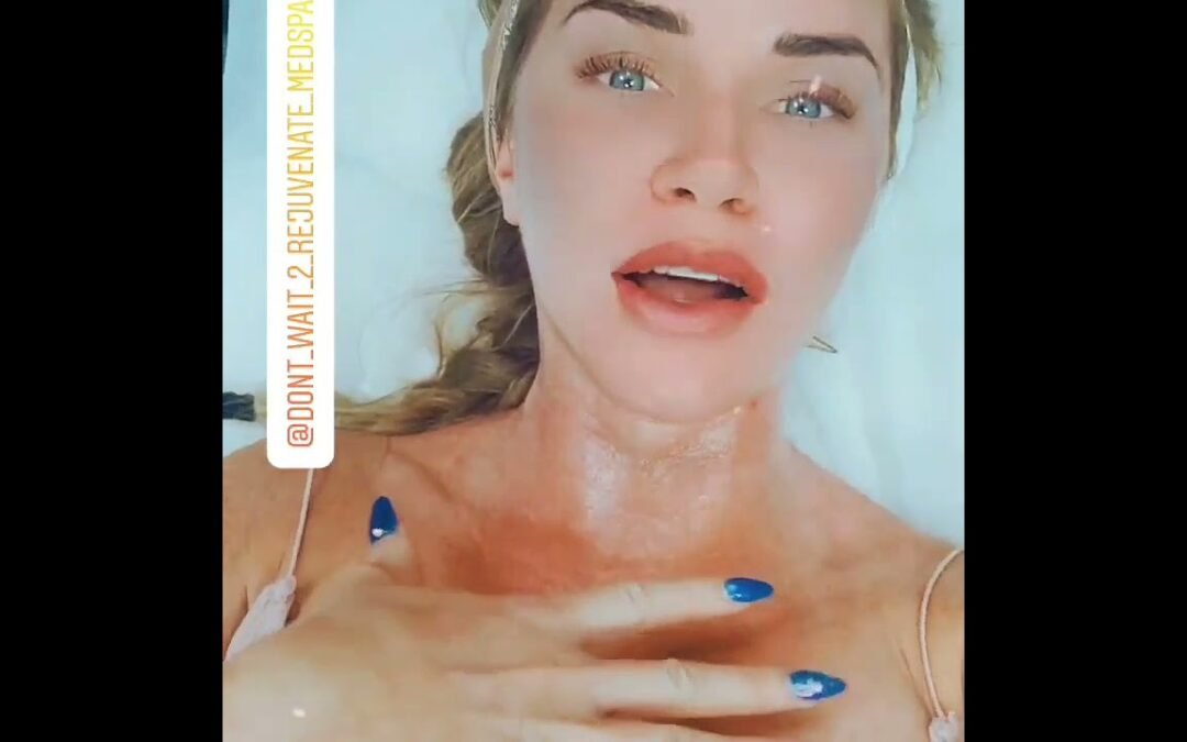 Video: Ultherapy in Orange County.  Follow @Anninetheesti for before and after photos