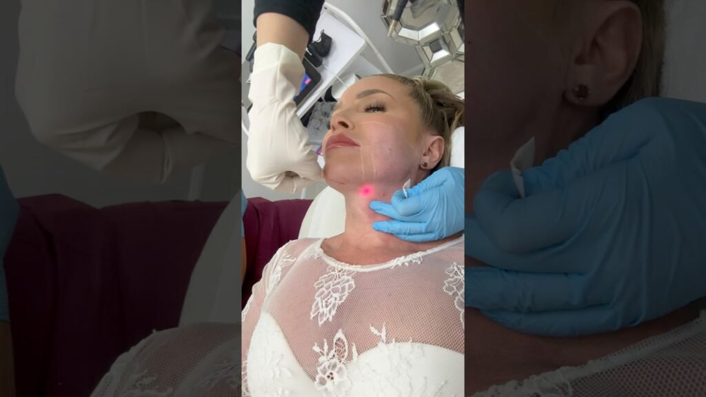 Endolift Procedure #endolift #procedure #antiaging #skintightening