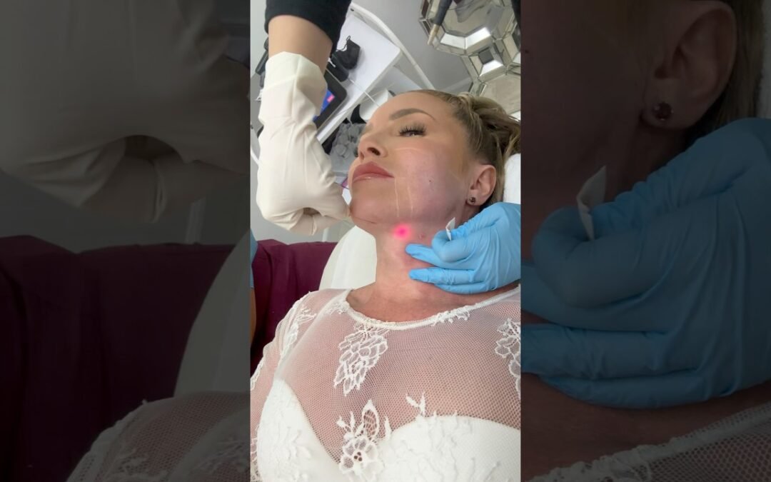 Video: Endolift Procedure #endolift #procedure #antiaging #skintightening