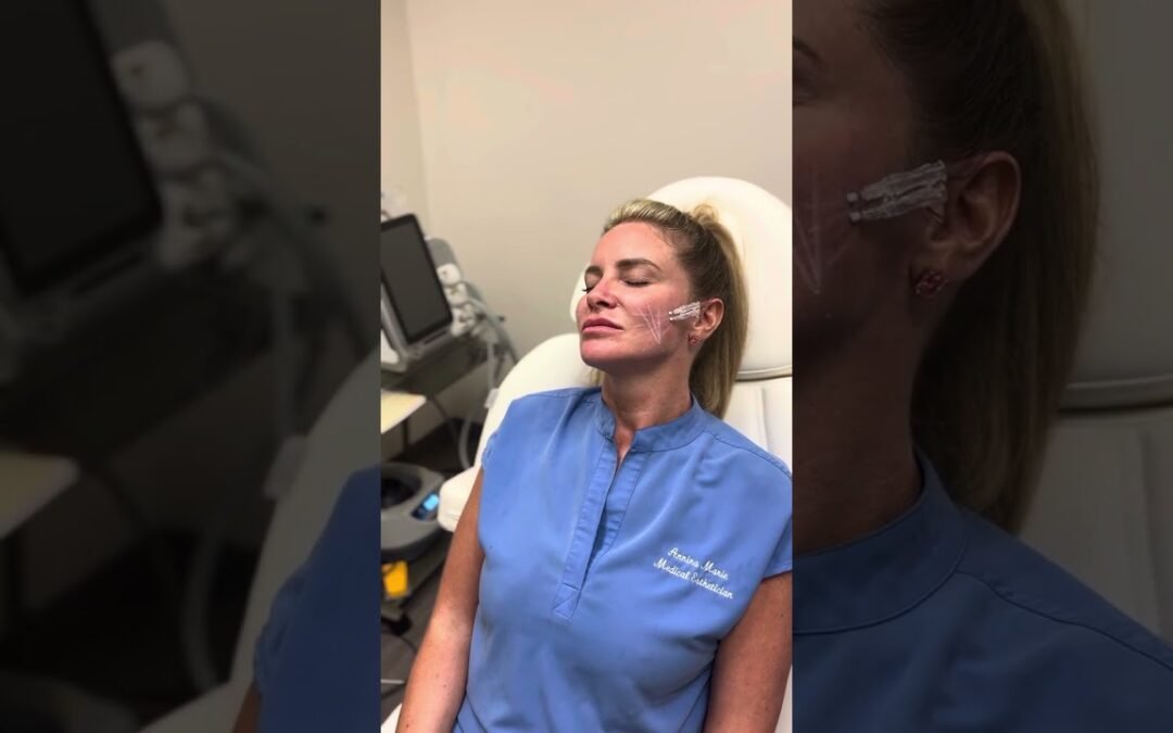 Video: Skin tightening with Smoothe threats at the medspa